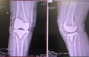 膝关节炎十年疼痛难忍，衢州骨伤科医院一招解决患者痛苦